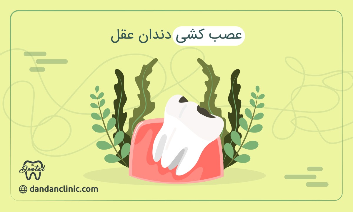 عصب کشی دندان عقل